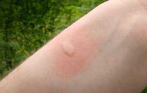 How-To-Get-Rid-Of-Mosquito-Bites-300x191